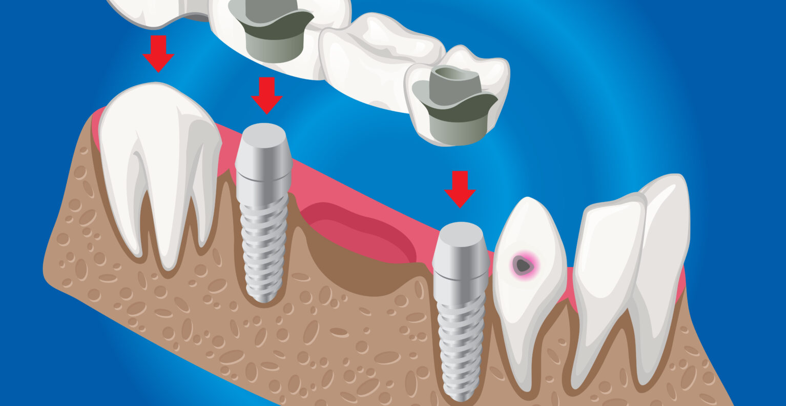 zubni implantati